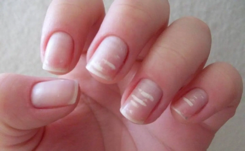 عوارض کمبود کلسیم بدن و راه‌های رفع آن: از کجا بفهمیم کمبود کلسیم داریم؟